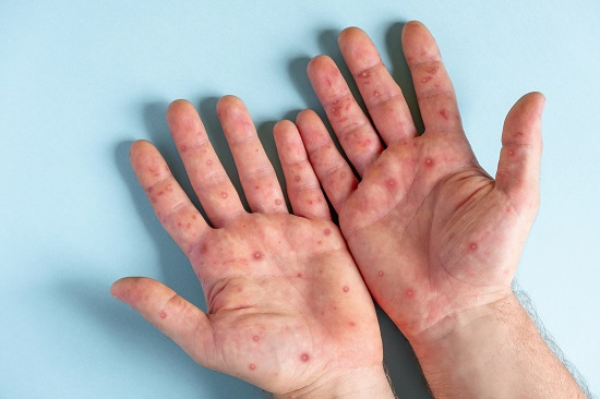 Male hands with Monkeypox rash. Patient with MonkeyPox viral disease. Close Up of Painful rash, red spots blisters on the skin. Human palm with Health problem. Banner, copy space. Allergy, dermatitis.