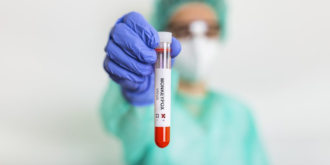 Monkeypox virus test. It is also known as the Moneypox virus, is a double-stranded DNA, zoonotic virus and a species of the genus Orthopoxvirus in the family Poxviridae