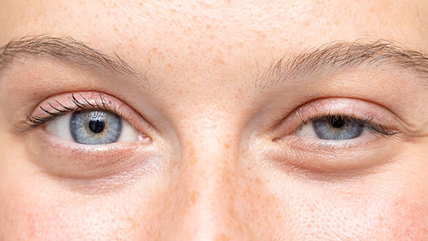 os-tipos-de-ptose-palpebral