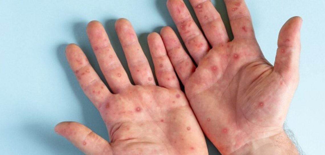 Male hands with Monkeypox rash. Patient with MonkeyPox viral disease. Close Up of Painful rash, red spots blisters on the skin. Human palm with Health problem. Banner, copy space. Allergy, dermatitis.
