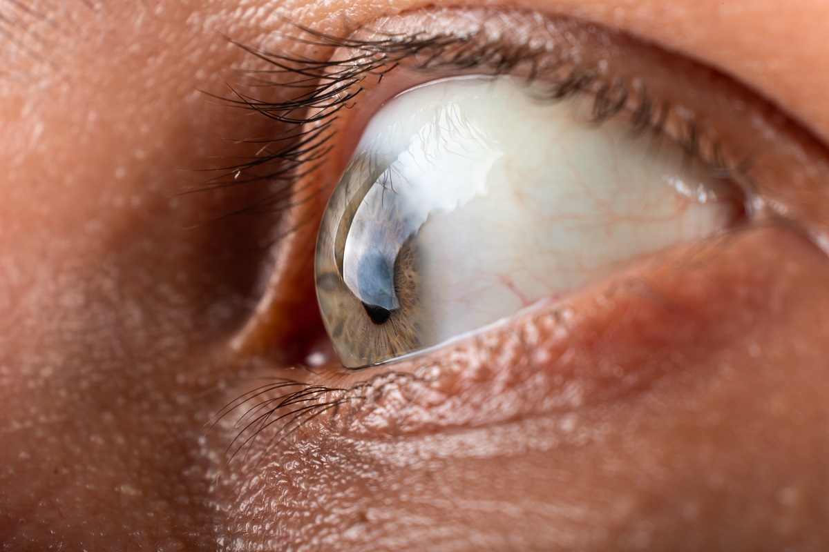 eye with corneal dystrophy closeup, keratoconus disease thinning of the cornea.